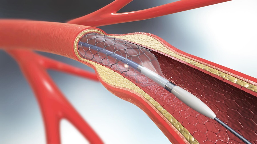 Illustration eines Herz-Stents